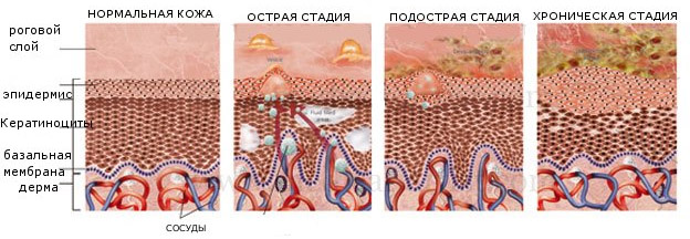 stadii-dermatologicheskogo-zabolevaniya